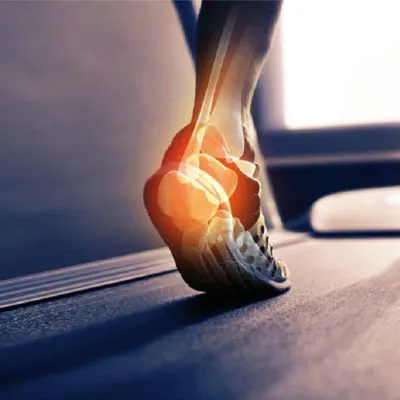 SCARPE E PLANTARI NELLA GESTIONE DEGLI INFORTUNI NELLA CORSA 