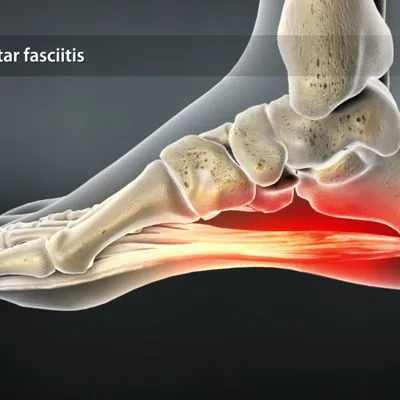 FASCITE PLANTARE : CAUSE E GESTIONE FISIOTERAPICA