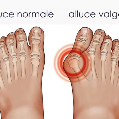 La fisioterapia dell’alluce valgo